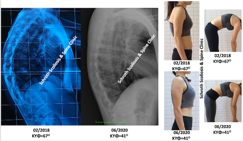 Σημαντική διόρθωση της κύφωσης σε ενήλικη γυναίκα, από τις 67 στις 41 μοίρες, εφαρμόζοντας μόνο ασκήσεις με την μέθοδο Schroth, στην Schroth Scoliosis & Spine Clinic. Η βελτίωση είναι εξίσου σημαντική στην στάση του σώματος της, αλλά και στις ενοχλήσεις που είχε πριν επισκεφτεί την κλινική μας. v.i.adult kyphosis correction schroth scoliosis spine clinic