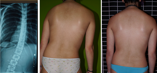 Patse McKenzie antalgic scoliosis disc herniation