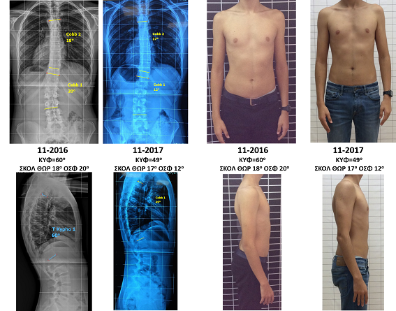 Πολύ σημαντική βελτίωση της κύφωσης από τις 60 στις 49 μοίρες, μέσα σε 12 μήνες, κατά την μέγιστη φάση ανάπτυξης του παιδιού. Σημαντικά βελτιώθηκε και η σκολίωση, από τις 20 στις 12 μοίρες, όπως και η συνολικότερη στάση σώματος του παιδιού. Έτσι, αποφεύχθηκε η εφαρμογή κηδεμόνα, που ήταν η αρχική σύσταση του γιατρού του. Dagres Schroth exercises scoliosis kyphosis improvement
