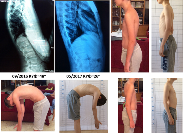 Σημαντική βελτίωση της κύφωσης σε νεαρό άτομο μέσα σε μερικούς μήνες, κάνοντας μόνο ασκήσεις με την μέθοδο Schroth. Από τις 48 μοίρες στις 26 μοίρες (χωρίς κηδεμόνα). Η σύσταση του γιατρού αρχικά ήταν να φορέσει κηδεμόνα για 22 ώρες την ημέρα. Η κύφωση διορθώθηκε, η στάση του παιδιού βελτιώθηκε σημαντικά και δεν χρειάστηκε να εφαρμοστεί κηδεμόνας. Eugenikos kyphosis improvement schroth exercises