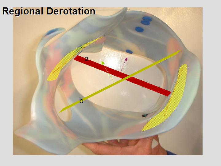 RSC brace derotation