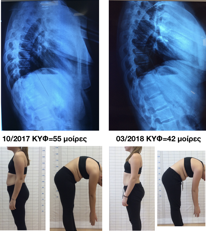 anastasatou kyphosis improvement schroth