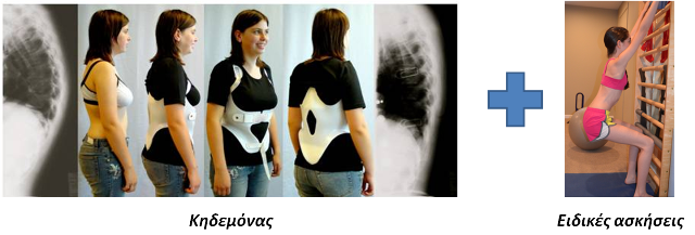 Ο συνδυασμός κηδεμόνα και ειδικών ασκήσεων για την κύφωση αποτελεί την καταλληλότερη θεραπεία για την κύφωση τύπου Scheuermann brace and exercises for scheuermann kyphosis