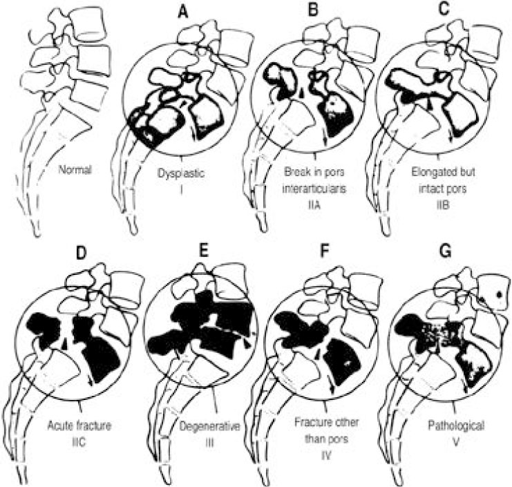 categories of spondylolisthesis