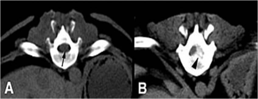ct myelography stenosis