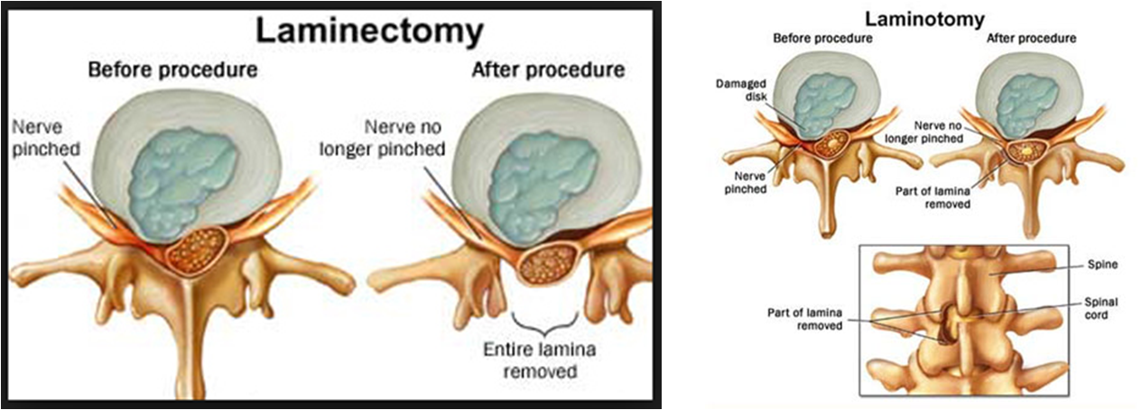 laminectomy and laminotomy