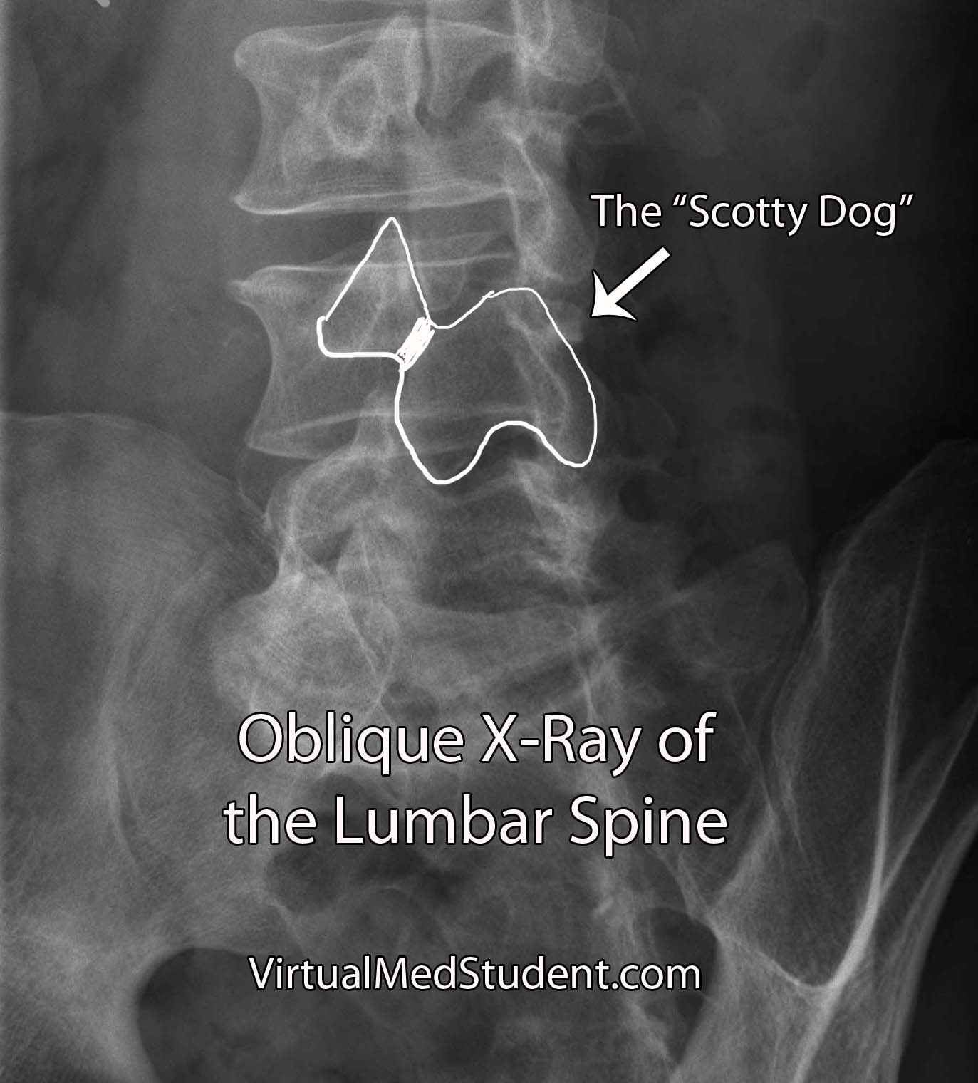 oblique xray spondylolisthesis