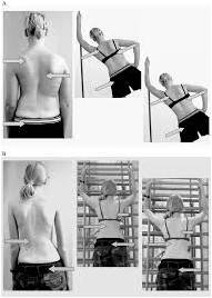 Schroth principles of correction