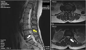 spinal stenosis MRI