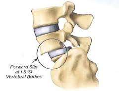 spondylolisthesis