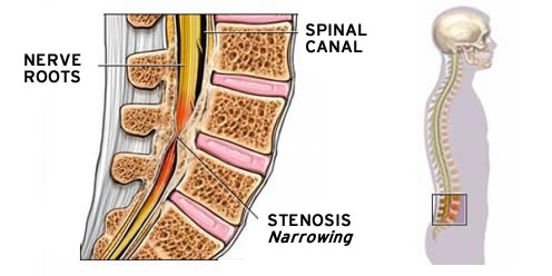 stenosis