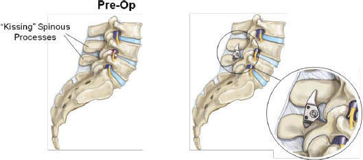 x-stop for spinal stenosis
