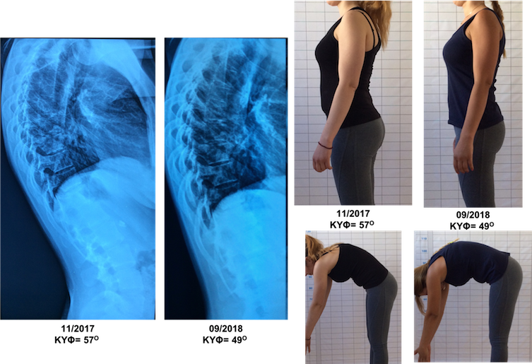 Σημαντική κλινική και ακτινολογική βελτίωση σε κύφωση ενηλίκου μέσα σε 10 μήνες. Η ασθενής ενώ παρουσιάστηκε στο κέντρο μας με σημαντικές ενοχλήσεις στην πλάτη, τώρα είναι πλήρως ασυμπτωματική, ενώ η στάση του σώματος της έχει βελτιώθει σημαντικά. Ntoulai kyphosis improvement schroth seas exercises