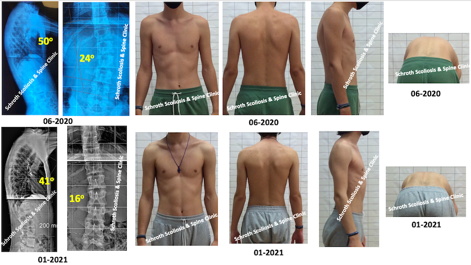 C.K.scoliosis and kyphosis treatment result Schroth Scoliosis Spine Clinic