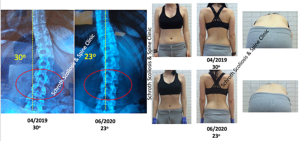 P.S.adult scoliosis treatment Schroth Scoliosis Spine Clinic