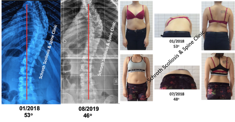 s.v. adult scoliosis treatment schroth scoliosis spine clinic 1