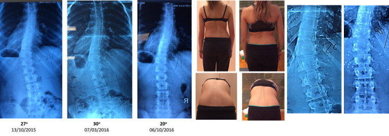 Mpoumpouli photos Schroth