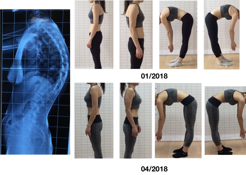 adult kyphosis clinical improvement schroth