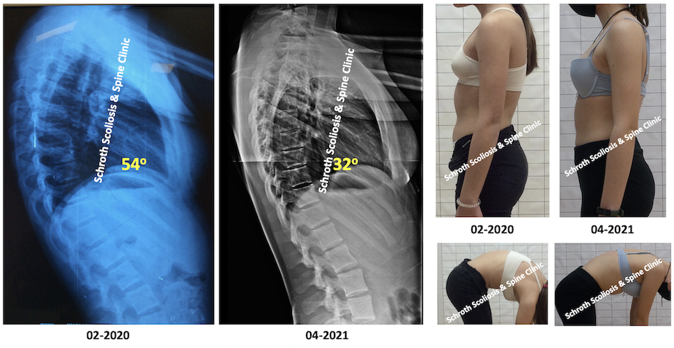 Διόρθωση της κύφωσης από τις 54 στις 32 μοίρες σε νεαρή κοπέλα, εφαρμόζοντας μόνο ασκήσεις Schroth, χωρίς κηδεμόνα, στην Schroth Scoliosis & Spine Cliniuc M.K. kyphosis treatment Schroth exercises no brace Schroth Scoliosis Spine Clinic