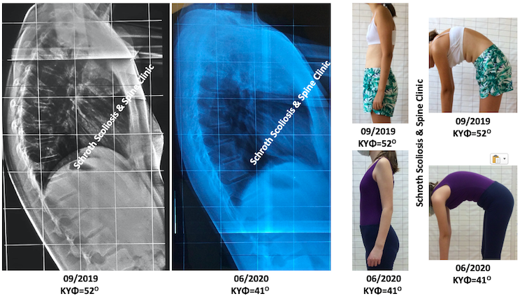 Σημαντική βελτίωση Εφηβικής κύφωσης, από τις 52 στις 41 μοίρες, εφαρμόζοντας μόνο ασκήσεις Schroth στην Schroth Scoliosis & Spine Clinic.  Ταυτόχρονα υπάρχει αξιοσημείωτη βελτίωση και στην στάση του σώματος. d.i.adolescent kyphosis treatment schroth scoliosis spine clinic
