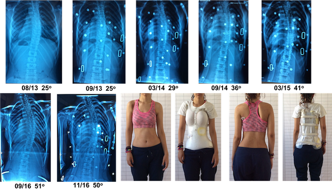 Αποτυχημένη αντιμετώπιση της σκολίωσης με τον κηδεμόνα DDB Mpatou DDB bad treatment result