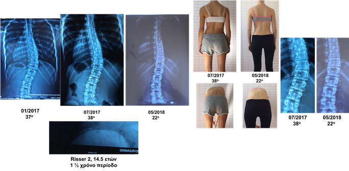 prevezanou schroth scoliosis treatment