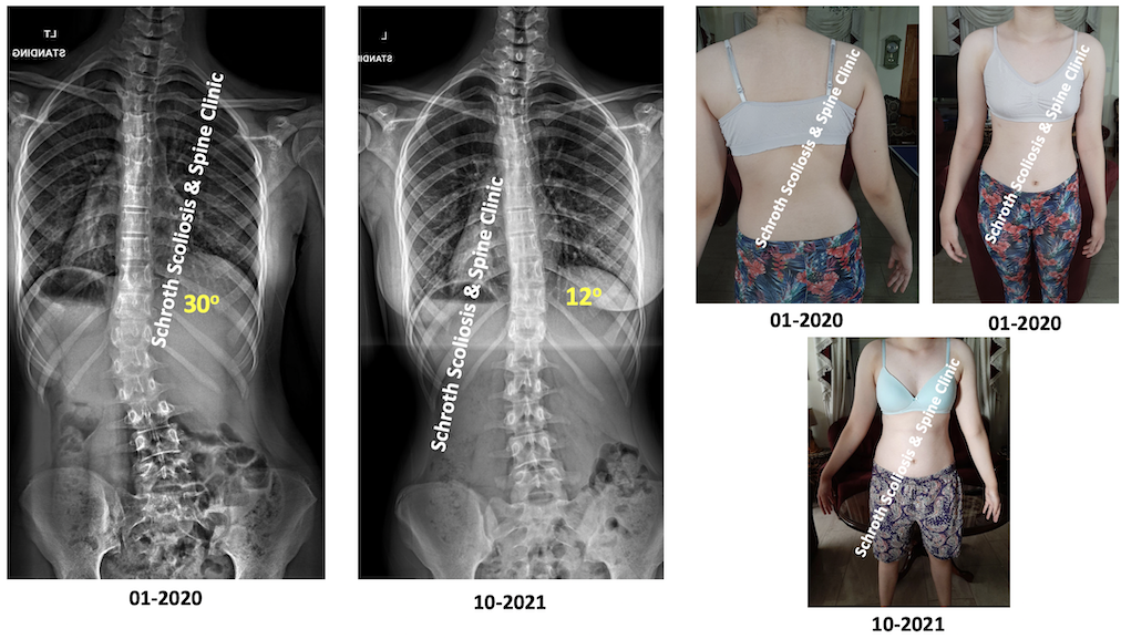 P.A. scoliosis treatment result brace and schroth exercises online Schroth Scoliosis Spine Clinic