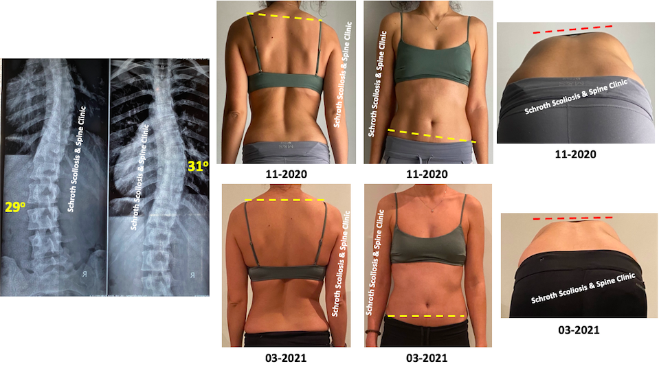 K.V. online Schroth scoliosis treatment Schroth Scoliosis Spine Clinic