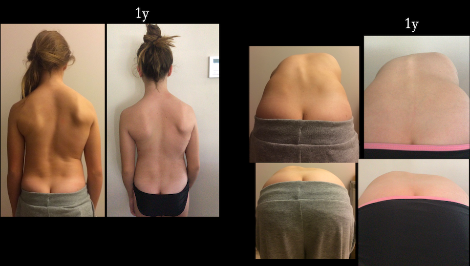 VBT result scoliosis treatment 4