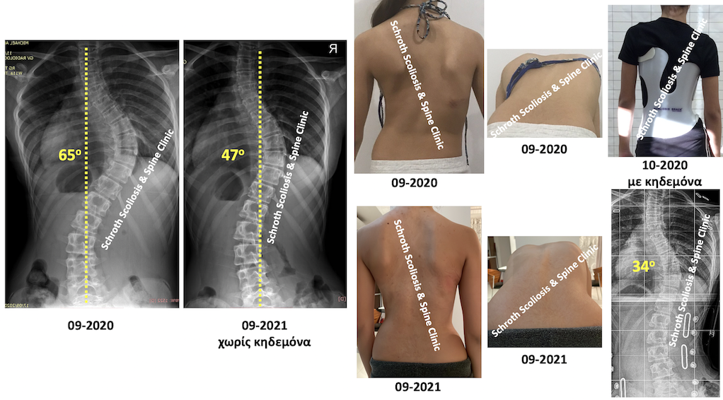 Σημαντική διόρθωση της σκολίωσης σε νεαρή κοπέλα εφαρμόζοντας κηδεμόνα και ασκήσεις Schroth στην Schroth Scoliosis & Spine Clinic M.A. scoliosis treatment result braceSchroth exercises Schroth Scoliosis Spine Clinic