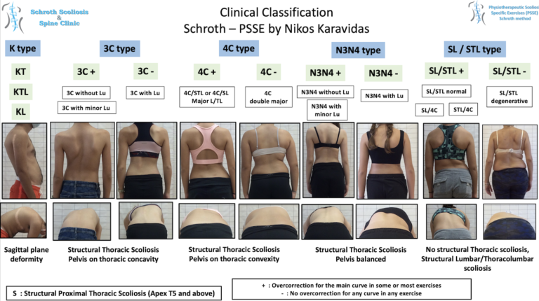 Clinical classification PSSE Schroth by Nikos Karavidas
